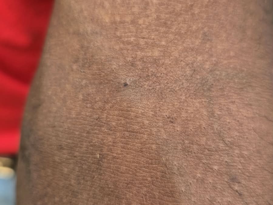 युवक ने खून निकलवाए जाने का निशान दिखाया।