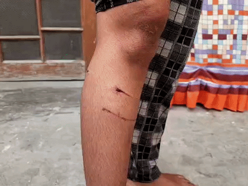 ओल्ड हाउसिंग बोर्ड की रहने वाली बिंदिया को भी उसी कुत्ते ने पैर पर काटा।