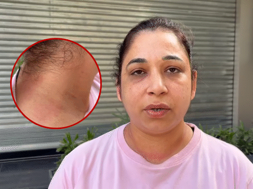 महिला से जब छीना झपटी की गई तो उसकी गर्दन पर निशान पड़ गया। इनसेट में गर्दन का निशान दिखाती महिला।