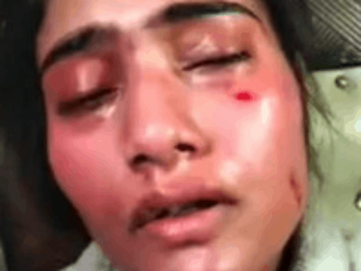 निशा ने अपने कुछ फोटो दिखाए, जिन्हें दिखाकर दावा किया कि उसे पति दविंदर ने पीटा था।