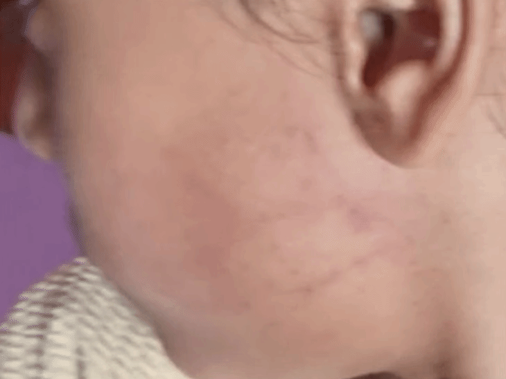 बच्ची के गाल पर थप्पड़ के निशान मिले हैं।