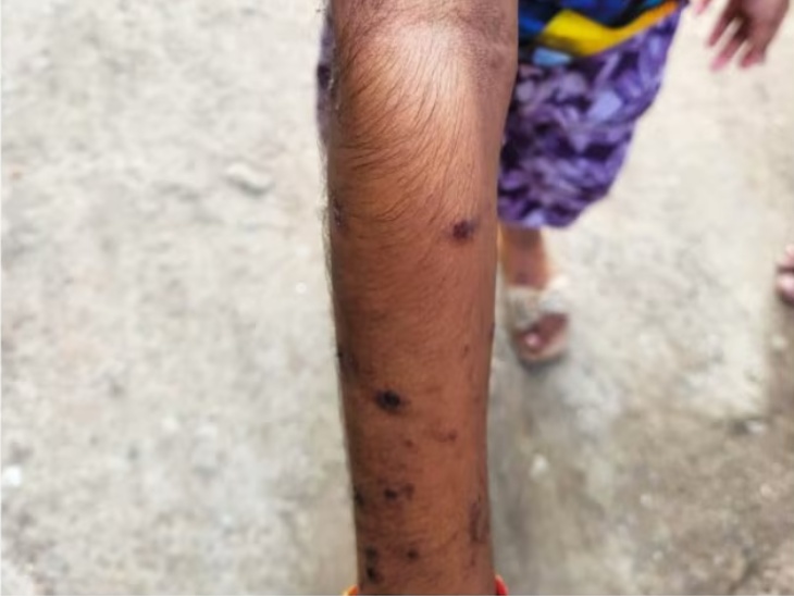 इस पानी के इस्तेमाल से कई लोगों के हाथ-पैर पर चकत्ते, छाले होने की बात सामने आई है।