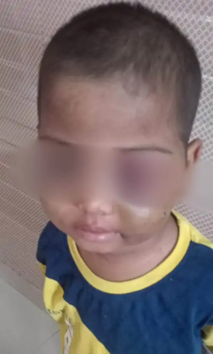 बच्चे की आंख चोट के कारण बुरी तरह सूज गई है।