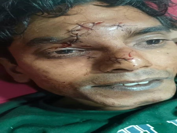 बंदर के हमले में घायल युलक के चेहरे पर लगे टांके।