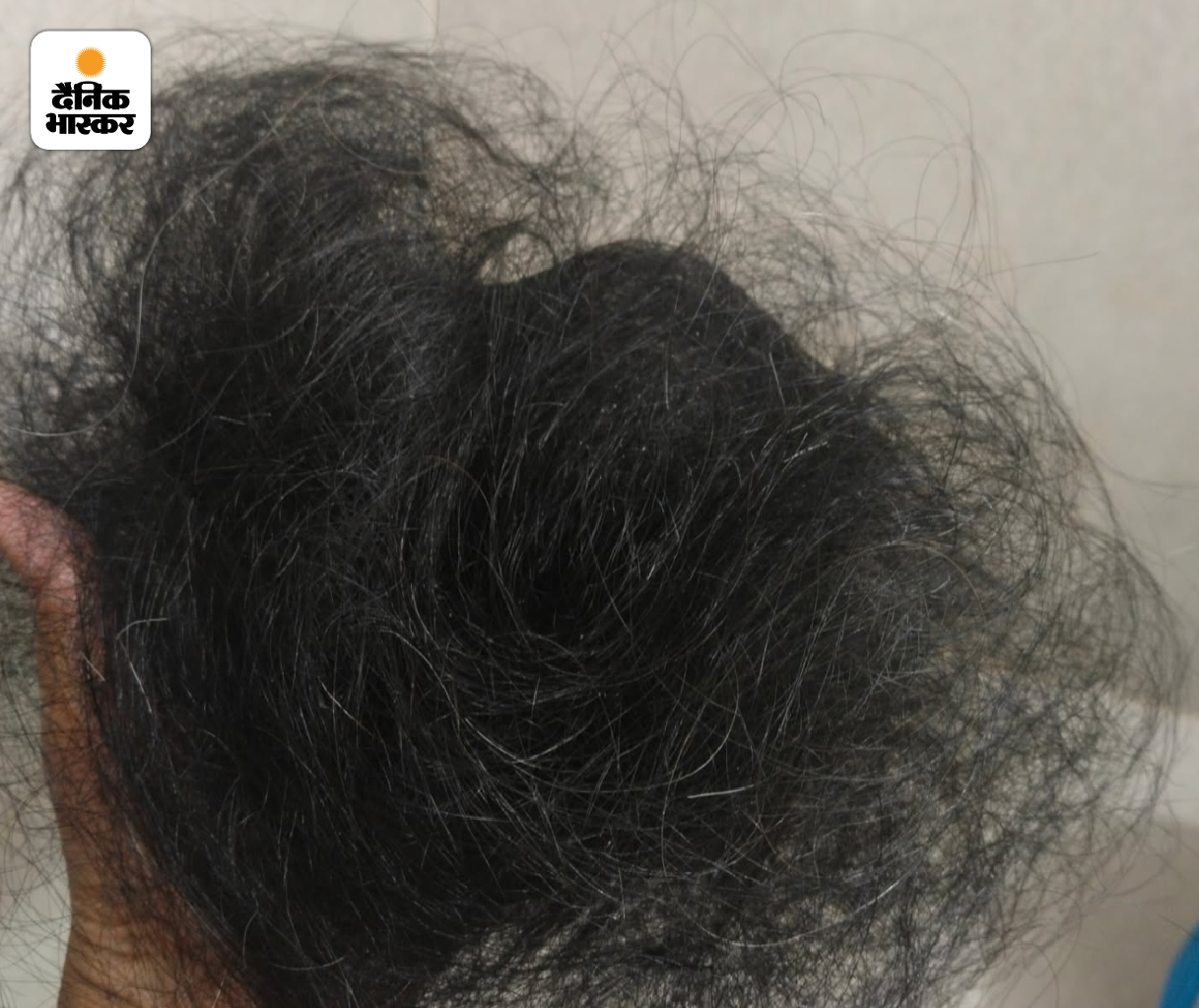 मनु बताती हैं, पहली कीमोथेरेपी के बाद ही उनके बाल झड़ने लगे। जब भी बालों में हाथ फेरतीं, बालों का एक गुच्छा हाथ में आ जाता।