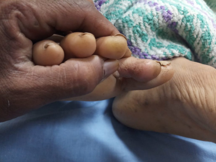 મહિલાના પગે સાપે ડંખ માર્યો