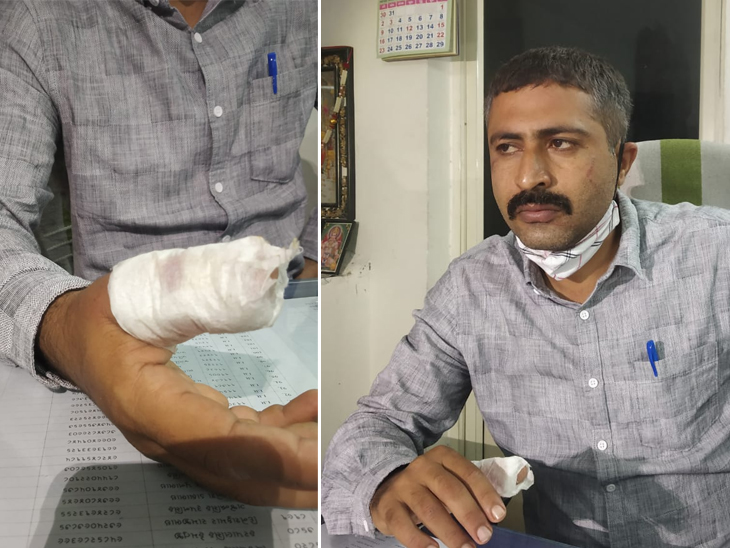 આરોપીએ PSIના જમણા હાથમાં બચકું ભરી લીધું હતું