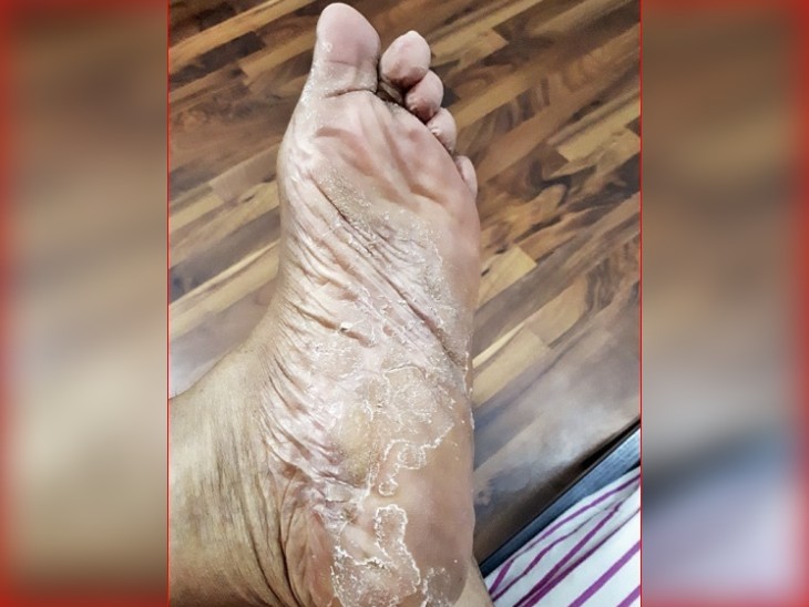 તપન મિશ્રાના શરીર પર આવેલા રિએક્શનની તસવીર