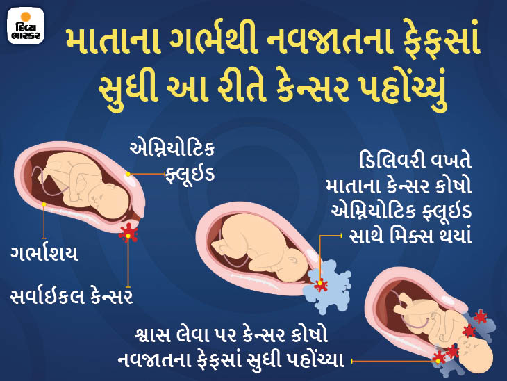 ડિલિવરી વખતે માતાના ગર્ભમાં જોડિયાં બાળકો સુધી કેન્સર પહોંચ્યું, વિશ્વમાં આવા માત્ર 20 કેસ|હેલ્થ,Health - Divya Bhaskar