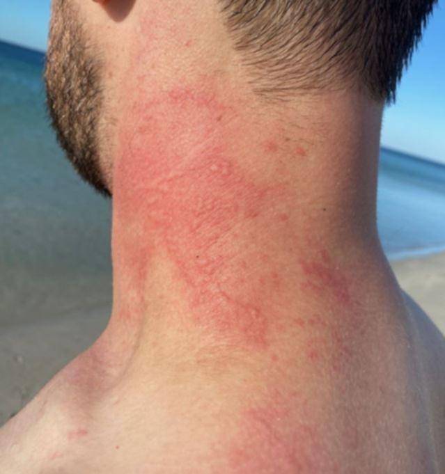 Octopus Rash ઓસ્ટ્રેલિયાના દરિયા કિનારે સ્વીમિંગની મોજ માણી રહેલા વ્યક્તિ પર ...