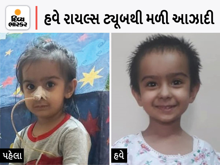 Food Tube Was Not There Since Birth, Even After Operation, Ate Food From Rice Tube, After Three Years Now Normal Food After Successful Operation | અન્નનળીમાં કાણું હતું, ટ્યૂબથી અપાતું હતું લિક્વિડ ડાયટ; 4 ઓપરેશન પછી મળી રાહત - Vimarsana News