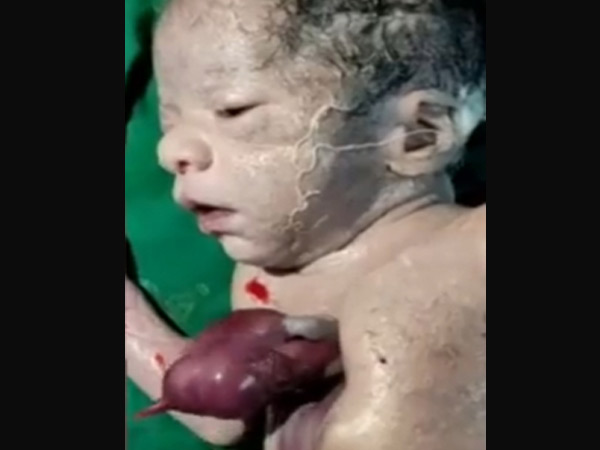 Birth of a child with heart outside the body in Himmatnagar Civil Hospital, 1 in 10 lakh such cases are seen. | હિંમતનગર સિવિલ હોસ્પિટલમાં શરીરની બહાર હૃદય સાથે બાળકનો જન્મ, 10 લાખે આવો 1 કેસ - Vimarsana News