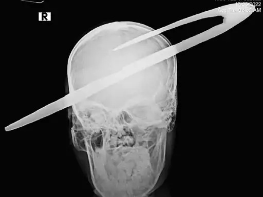 Surprise, a toothpick penetrated the teen's head about two inches - neither bleeding nor pain.
