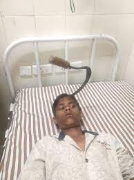 ડોકટરોએ ઓપરેશન બાદ કિશોરનાં માથામાંથી દાતરડું દૂર કર્યું હતું.