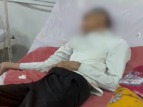 Surat Acid Attack: Elderly Man Throws Acid on Wife in Alimony Case