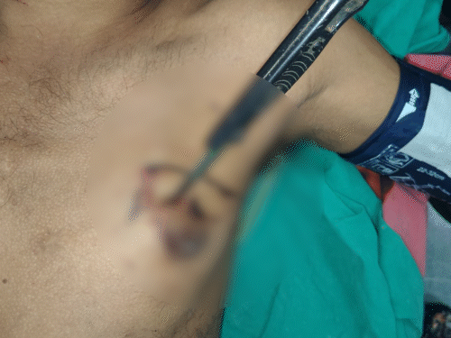 Miraculous Surgery in Surat