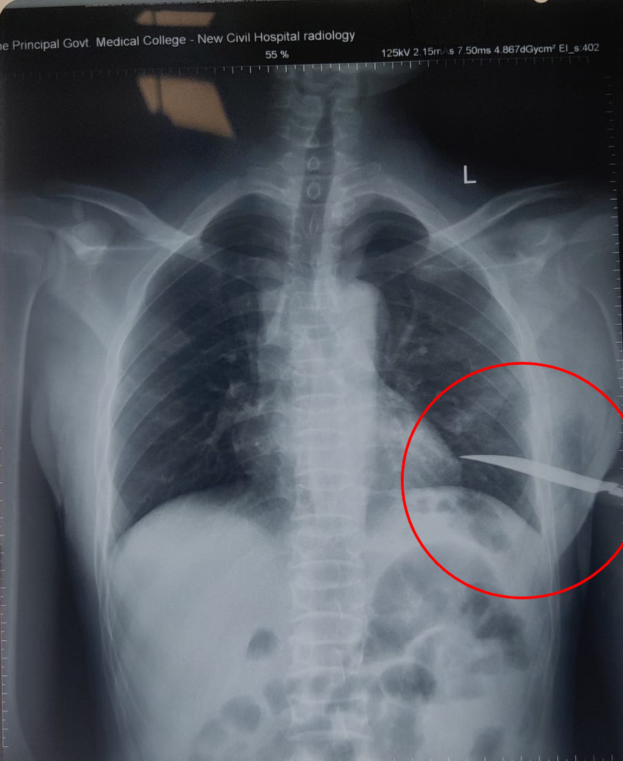 Miraculous Surgery in Surat