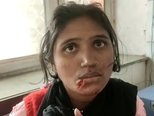 एकतरफा प्यार में विवाहिता पर चाकू से वार:महिला का होंठ कटकर अलग हुआ, पुलिस हिरासत में युवक