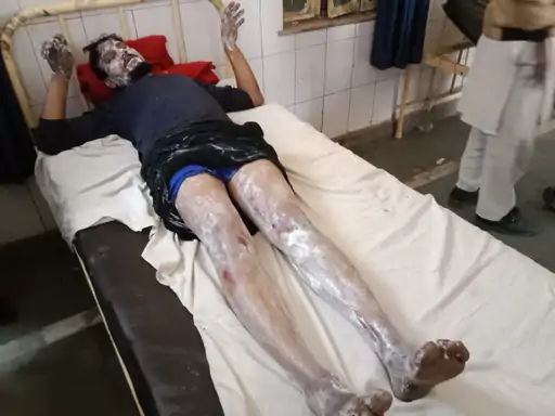 धमाके के साथ फटा केमिकल का खाली ड्रम:एक बच्चे समेत तीन झुलसे, गरम ब्लेड से काटते समय हुआ हादसा